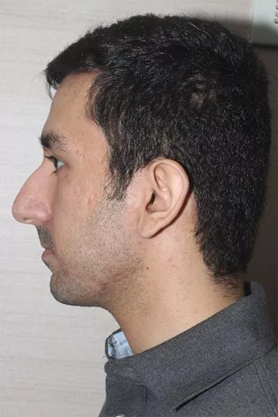 Male patient before primary rhinoplasty