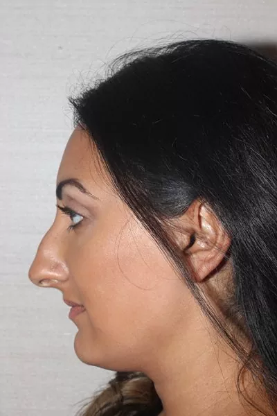 Female patient before primary rhinoplasty