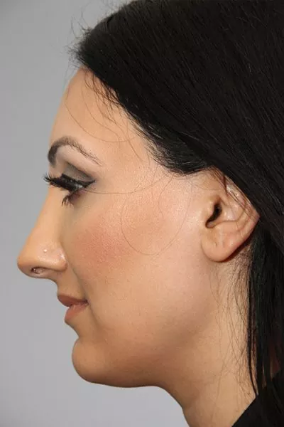 Female patient after primary rhinoplasty