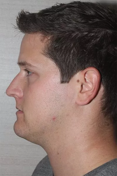 Male patient before primary rhinoplasty