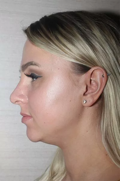 Female patient after primary rhinoplasty