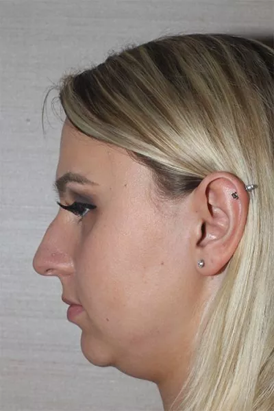 Female patient before primary rhinoplasty