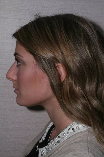 Female patient before primary rhinoplasty