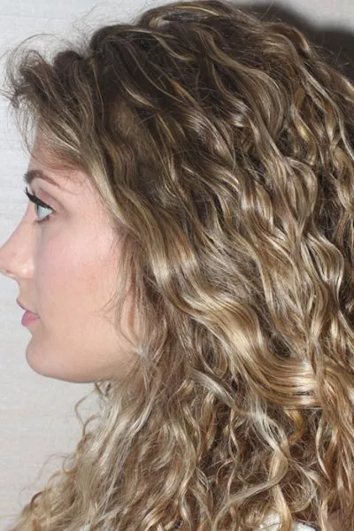 Female patient after primary rhinoplasty