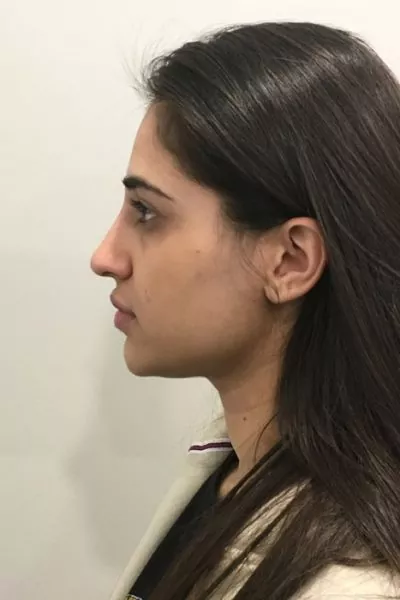 Female patient before injectable rhinoplasty