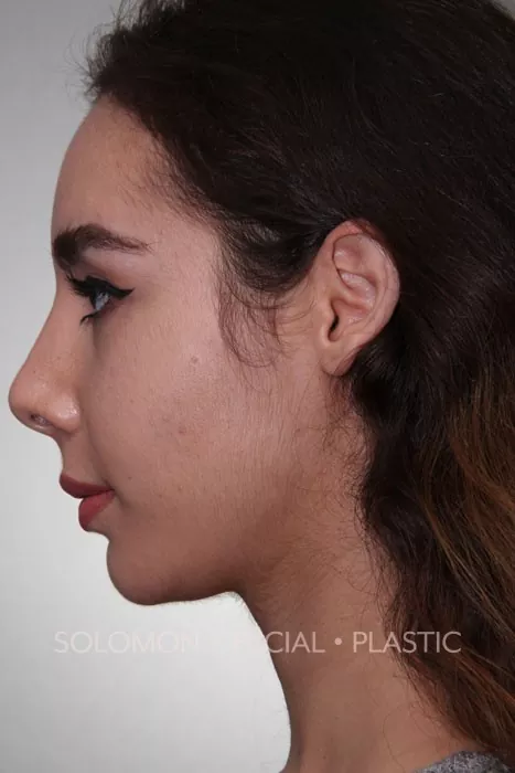 Female patient after primary rhinoplasty