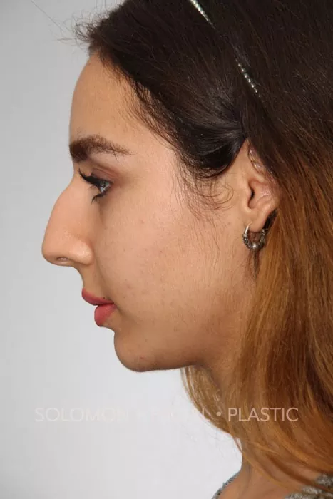 Female patient before primary rhinoplasty