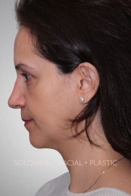 Female patient after primary rhinoplasty