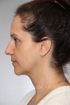 Female patient before primary rhinoplasty