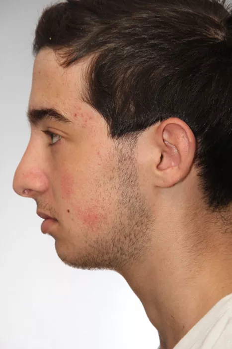 Male patient after primary rhinoplasty