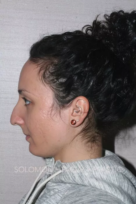 Female patient before primary rhinoplasty