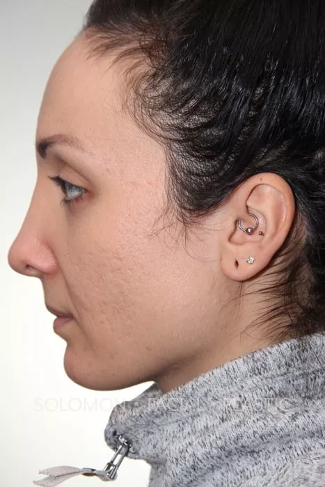 Female patient after primary rhinoplasty