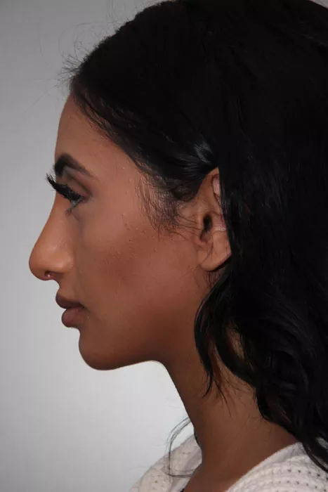 Female patient after primary rhinoplasty