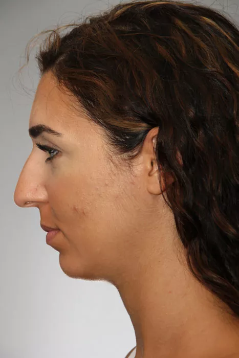 Female patient before primary rhinoplasty