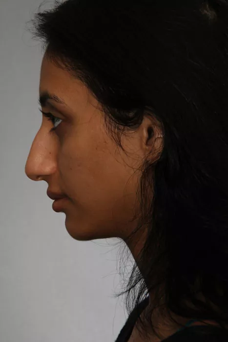 Female patient before primary rhinoplasty