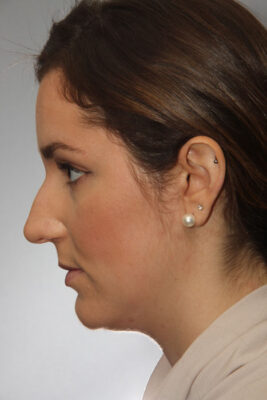 Female patient before primary rhinoplasty