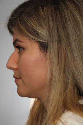 Female patient before primary rhinoplasty