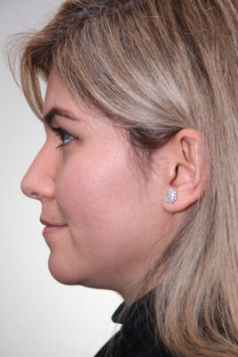 Female patient after primary rhinoplasty