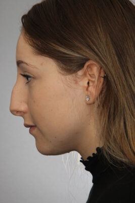Female patient before primary rhinoplasty