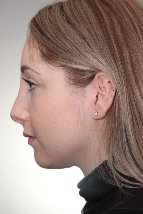 Female patient after primary rhinoplasty