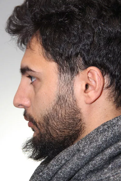 Male patient after primary rhinoplasty