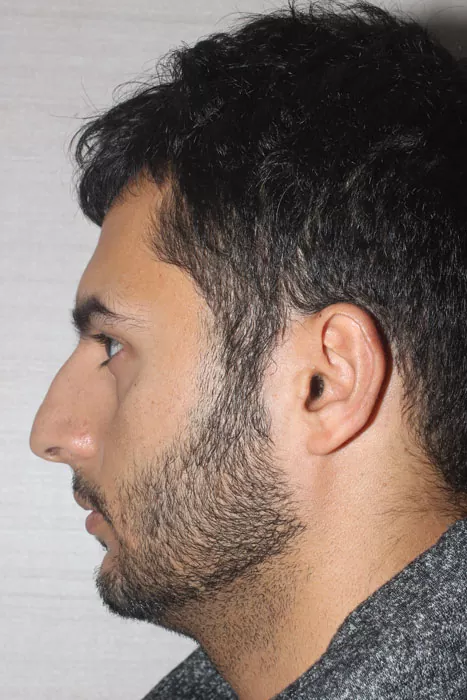 Male patient before primary rhinoplasty