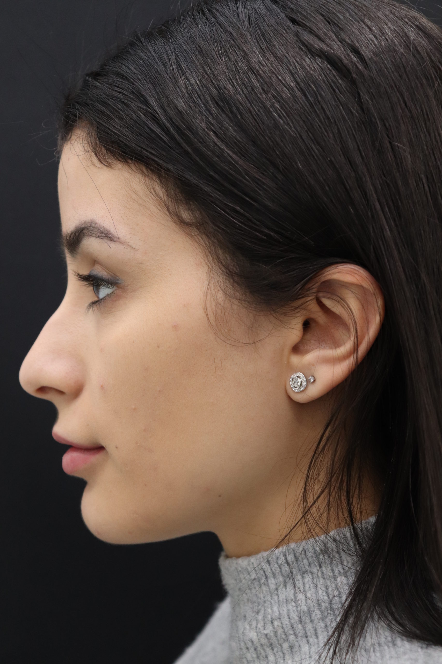 Primary rhinoplasty side profile before