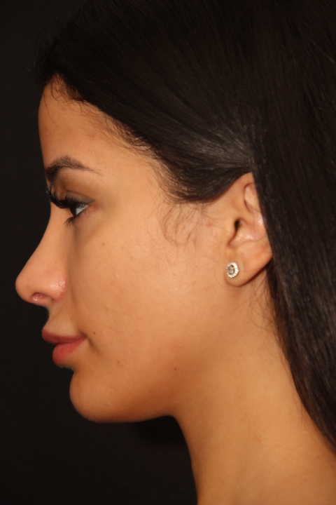 Primary rhinoplasty side profile after