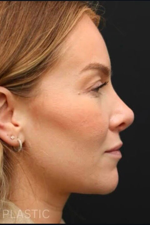 woman after primary rhinoplasty