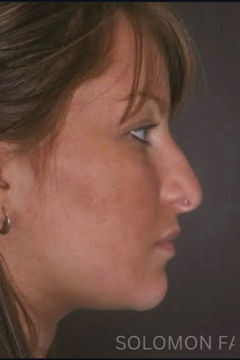 Woman before primary rhinoplasty