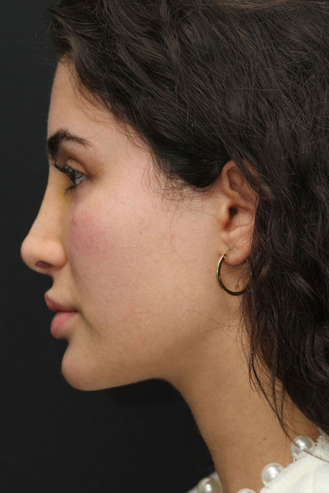 primary rhinoplasty after