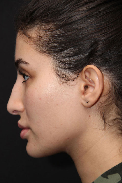 primary rhinoplasty before