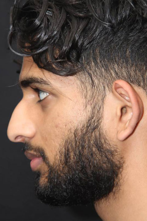 man before primary rhinoplasty