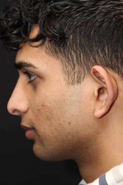 man after primary rhinoplasty