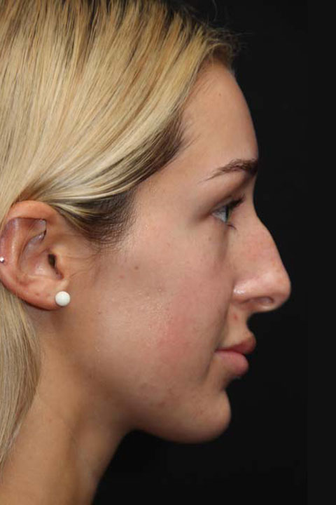Primary rhinoplasty before profile