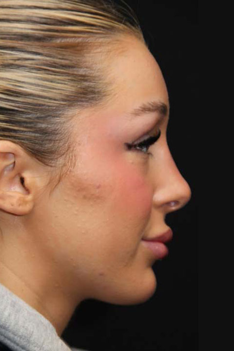 Primary rhinoplasty after profile
