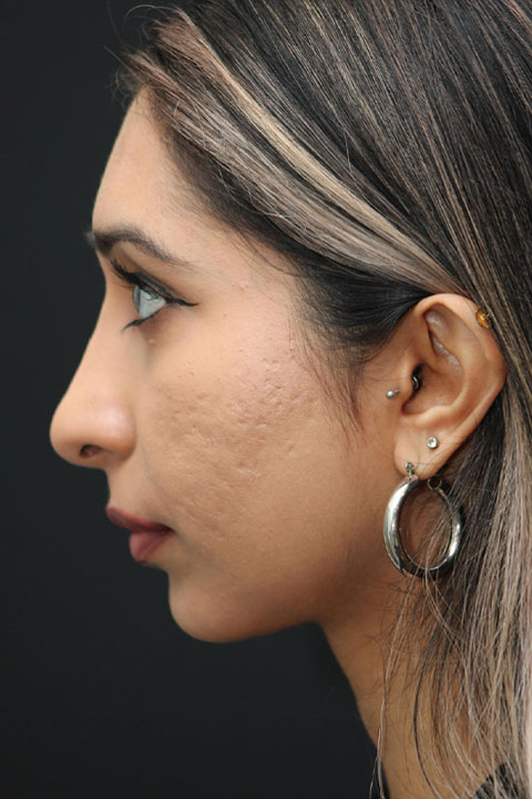 After nose reshaping