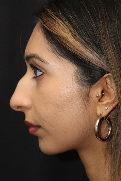 Before nose reshaping