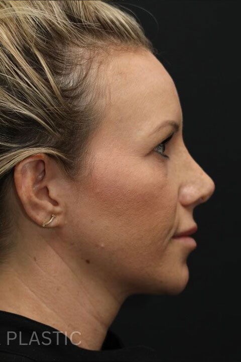 Post - rhinoplasty side view