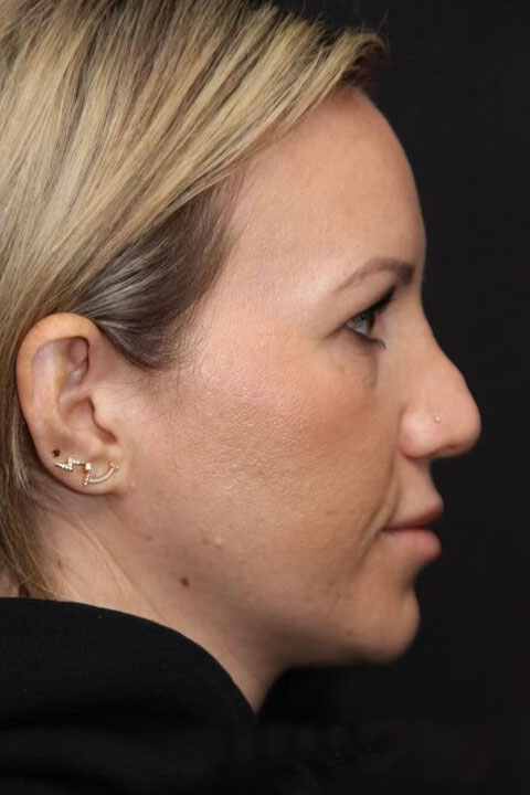 Pre-rhinoplasty side view
