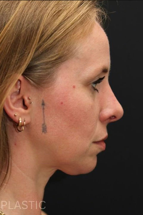 Nose profile after rhinoplasty