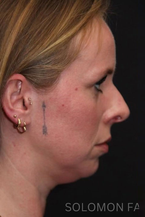 Nose appearance before rhinoplasty