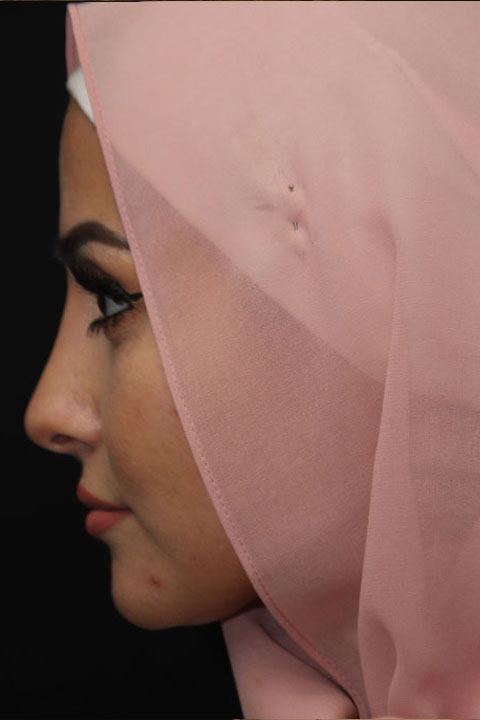Post-surgery nose contour