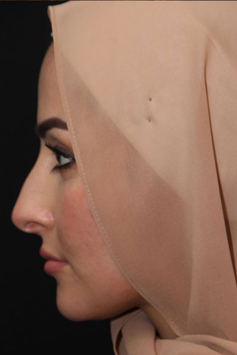 Pre-surgery nose profile