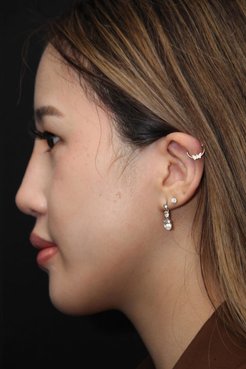 After cosmetic nose surgery