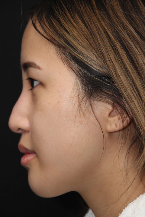 Before cosmetic nose surgery