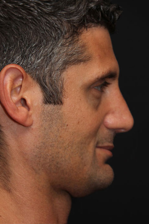 Enhanced side profile result