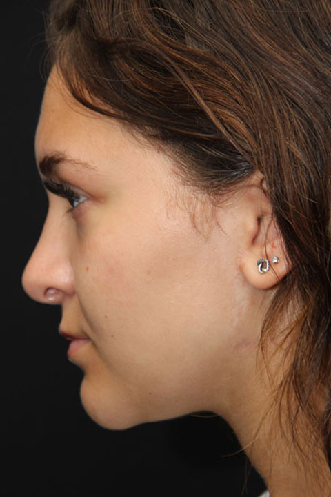 Smooth nose contour after surgery