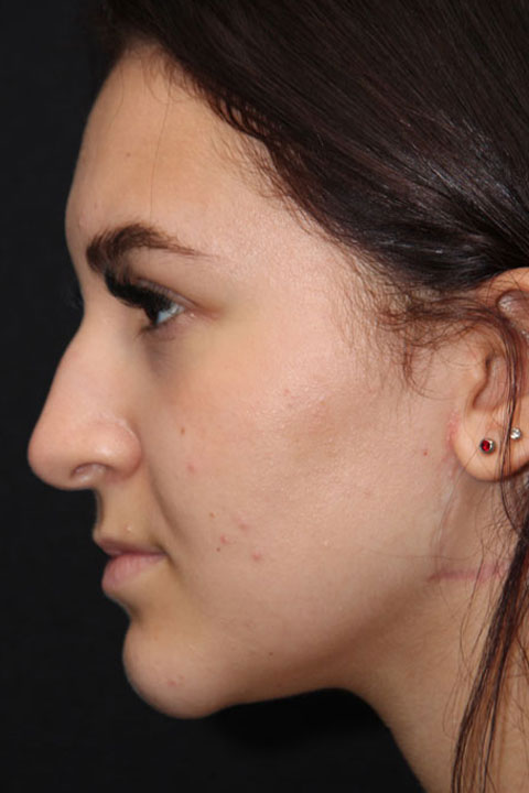 Before nose contour refinement