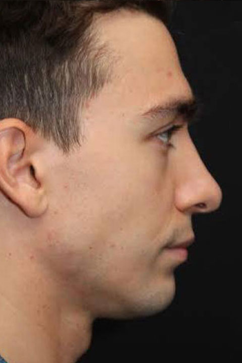 Enhanced nasal contour result